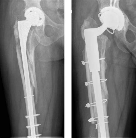 Total Hip Replacement / Revision .